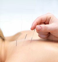 Acupuncture